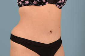 Abdominoplasty Before & After Image