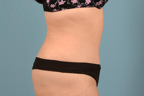 Abdominoplasty Before & After Image