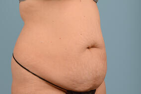 Abdominoplasty Before & After Image