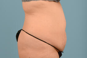 Abdominoplasty Before & After Image