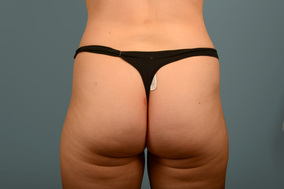 Liposuction Before & After Image