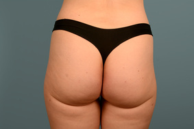 Liposuction Before & After Image