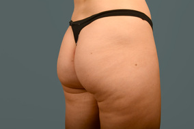 Liposuction Before & After Image