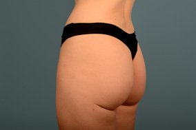 Liposuction Before & After Image