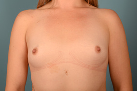 Breast Augmentation Before & After Image