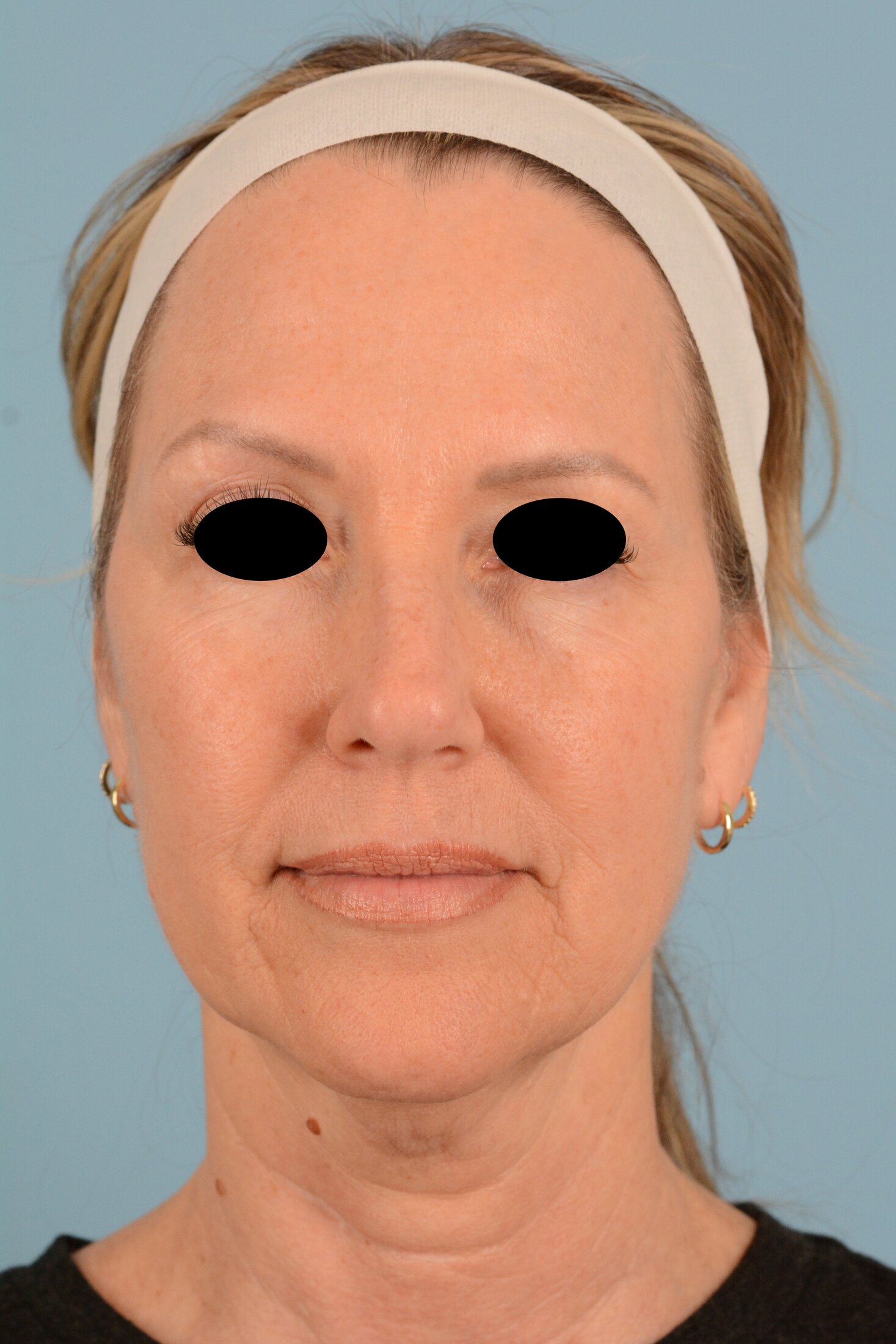 Facelift Before & After Image