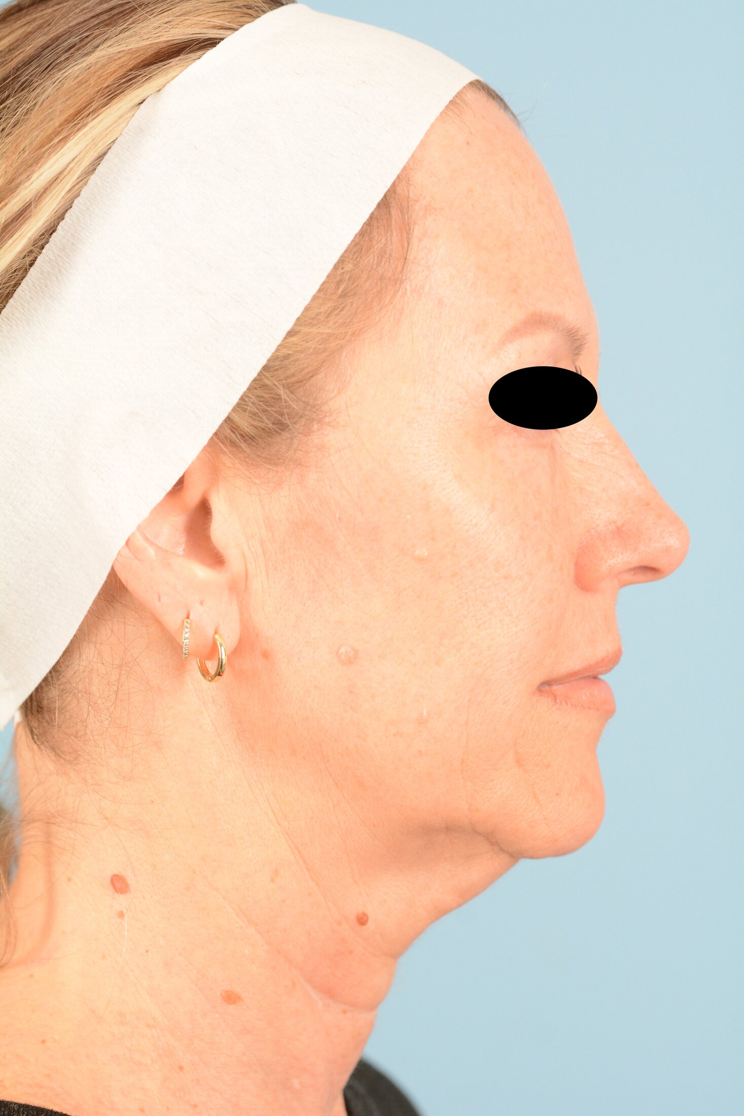 Facelift Before & After Image