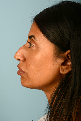 Rhinoplasty Before & After Image