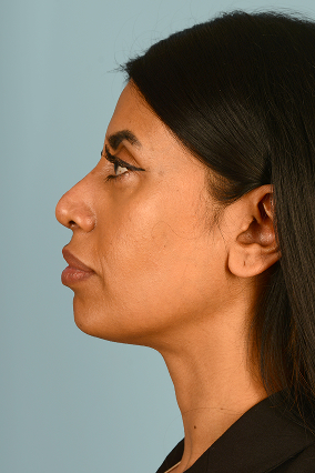 Rhinoplasty Before & After Image