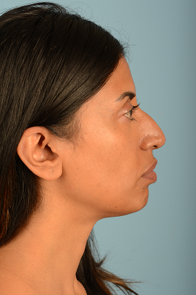 Rhinoplasty Before & After Image