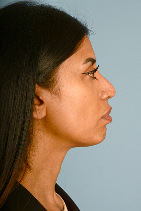 Rhinoplasty Before & After Image