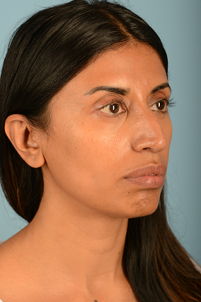 Rhinoplasty Before & After Image