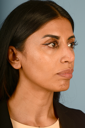 Rhinoplasty Before & After Image