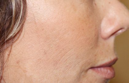 Microneedling Before & After Image