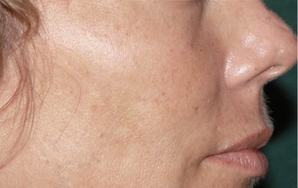 Microneedling Before & After Image