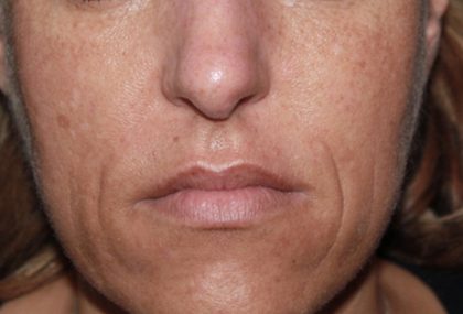 Microneedling Before & After Image