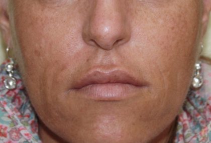 Microneedling Before & After Image