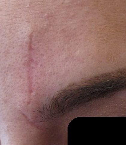 Microneedling Before & After Image