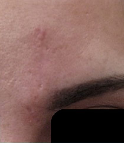 Microneedling Before & After Image