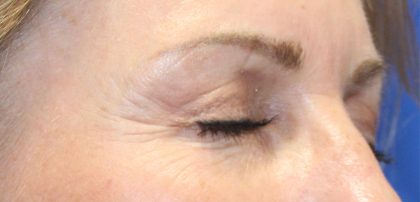 Microneedling Before & After Image