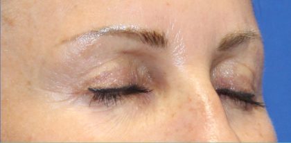 Microneedling Before & After Image